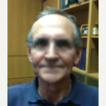 65-74 year old man treated with ARTAS Robotic Hair Transplant before 3066755