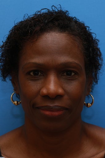 Young lady concerned with heavy brows and stern appearance (Browlift for African-American woman) before 1317758