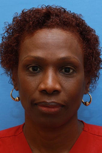 Young lady concerned with heavy brows and stern appearance (Browlift for African-American woman) after 1317758