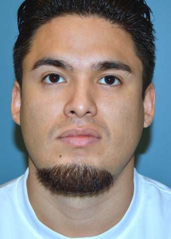 Male Rhinoplasty 1346653