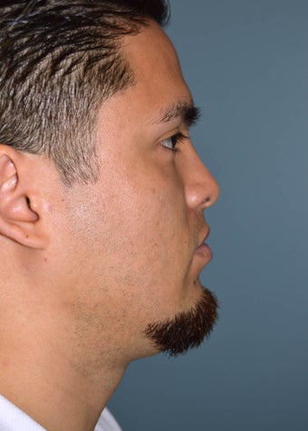 Male Rhinoplasty after 1346653