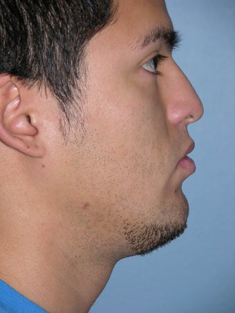 Male Rhinoplasty before 1346653