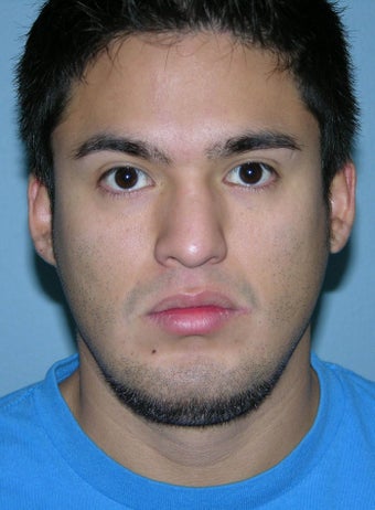Male Rhinoplasty 1346653