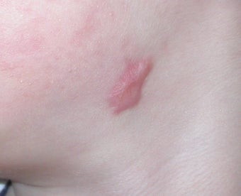 6 year old boy with persistent facial scar before 694350