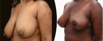 African American Breast Reduction before 1141931