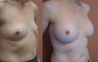 Breast Implants before 974249