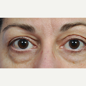 35-44 year old woman treated with Eyelid Surgery before 3761591