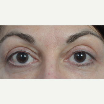 35-44 year old woman treated with Eyelid Surgery after 3761591