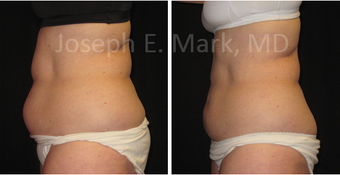 45-54 year old woman treated with CoolSculpting before 3660557