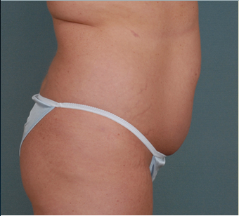 Butt Augmentation before 1376883