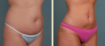 Butt Augmentation 1376883
