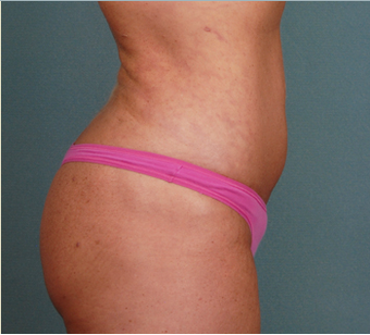 Butt Augmentation after 1376883