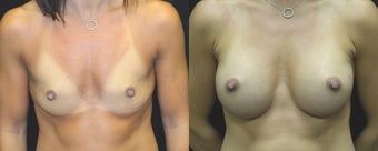 35 year old woman treated with Breast Augmentation before 3004735