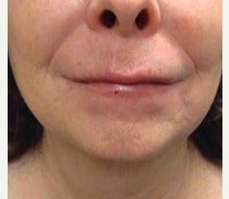 55-64 year old woman treated with Restylane Silk after 2490944