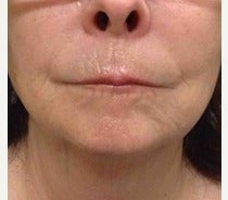 55-64 year old woman treated with Restylane Silk before 2490944