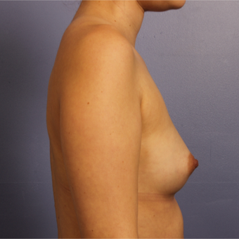 25-34 year old woman treated with Breast Augmentation before 3657239