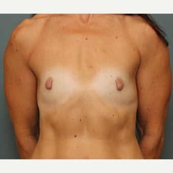 45-54 year old woman treated with Breast Augmentation before 3031170