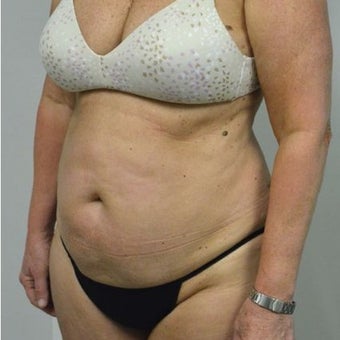 65-74 year old woman treated with Tummy Tuck before 2149098