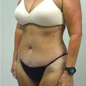 65-74 year old woman treated with Tummy Tuck after 2149098