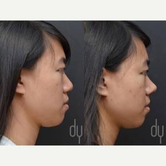 18-24 year old woman treated with Asian Rhinoplasty before 3622598