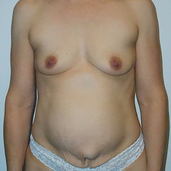 35-44 year old woman treated with Mommy Makeover before 3125597