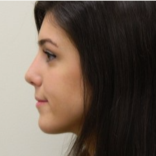 18-24 year old woman treated with Rhinoplasty after 3459429