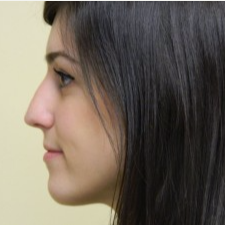 18-24 year old woman treated with Rhinoplasty before 3459429