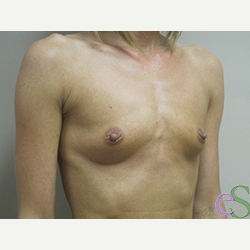 Breast Implants before 3373664