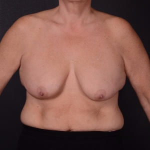 45-54 year old woman treated with Breast Lift with Implants before 3737513