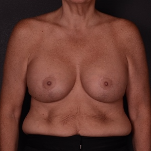 45-54 year old woman treated with Breast Lift with Implants after 3737513