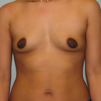 Breast Augmentation on 5ft3, 138 pound patient before 3026957