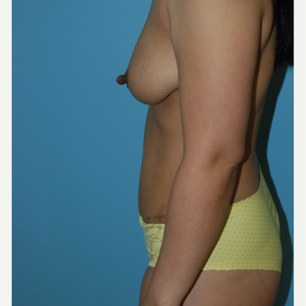 35-44 year old woman treated with Tummy Tuck after 3061222