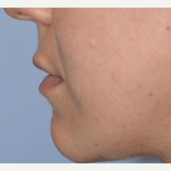 28 year old woman treated with Restylane Silk after 3763142