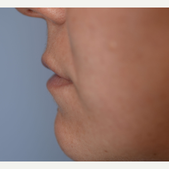 28 year old woman treated with Restylane Silk before 3763142