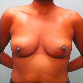 33 year old woman treated with Breast Lift after 3467373