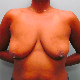 33 year old woman treated with Breast Lift before 3467373