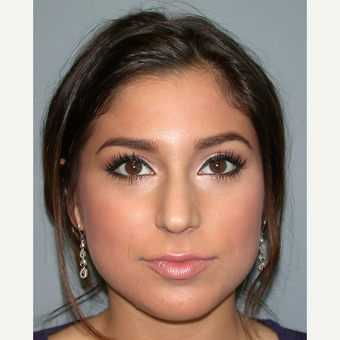 18-24 year old woman treated with Rhinoplasty before 3685198