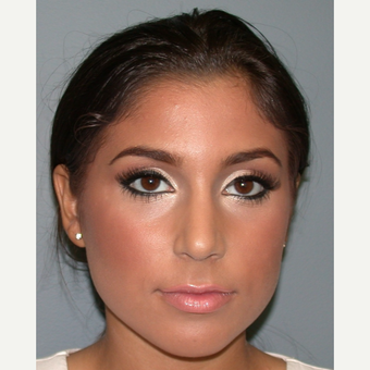 18-24 year old woman treated with Rhinoplasty after 3685198