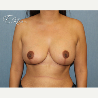 35-44 year old woman treated with Breast Lift with Implants after 3102572