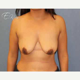 35-44 year old woman treated with Breast Lift with Implants before 3102572