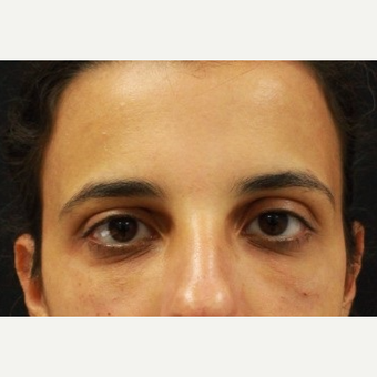 27 year old female, tear trough injection with Belotero by Dr. Patel after 3110383