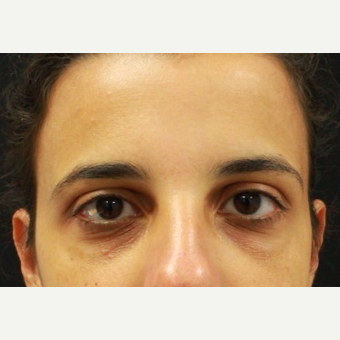 27 year old female, tear trough injection with Belotero by Dr. Patel before 3110383