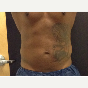 35-44 year old man treated with SculpSure after 3624905