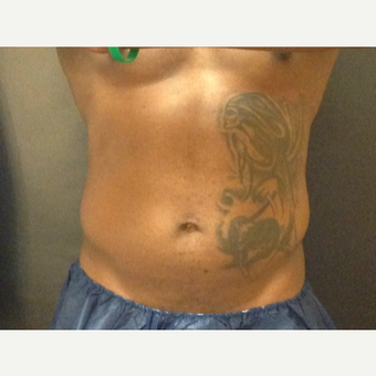 35-44 year old man treated with SculpSure before 3624905