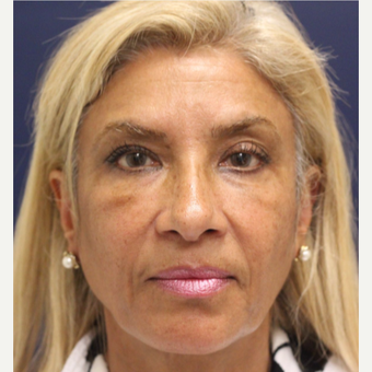 45-54 year old woman treated with Bellafill after 3143426