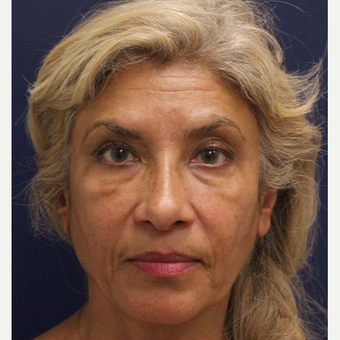 45-54 year old woman treated with Bellafill before 3143426