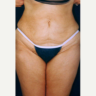 35-44 year old woman treated with Liposuction after 3646556