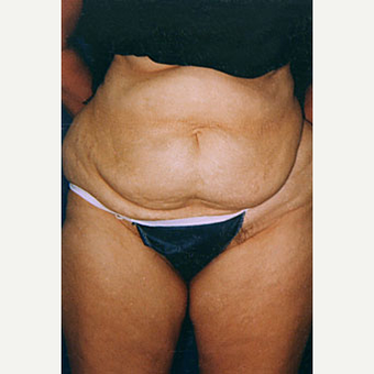 35-44 year old woman treated with Liposuction before 3646556