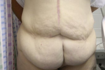 Panniculectomy on 29 Year Old Female before 1101130