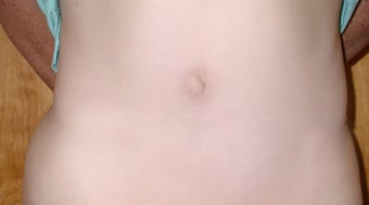 Panniculectomy on 29 Year Old Female after 1101130